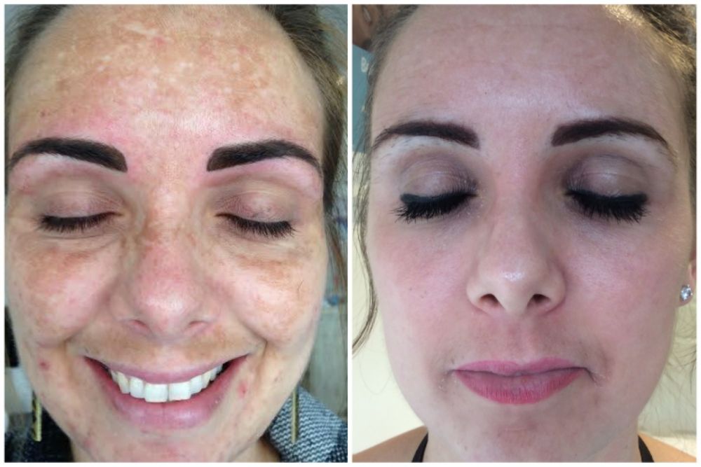 Luciderm offer world leading treatment for Melasma