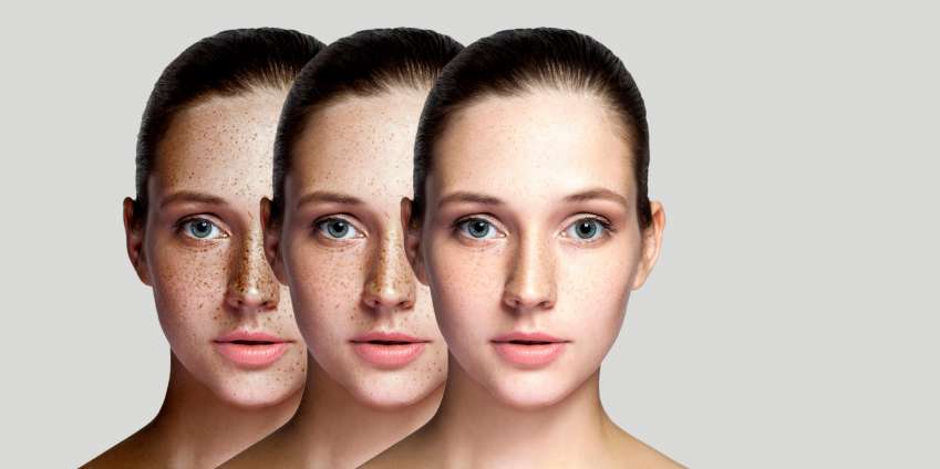 Pigmentation Treatment